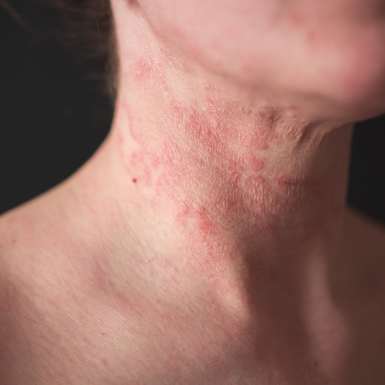Peaux atopiques & eczéma