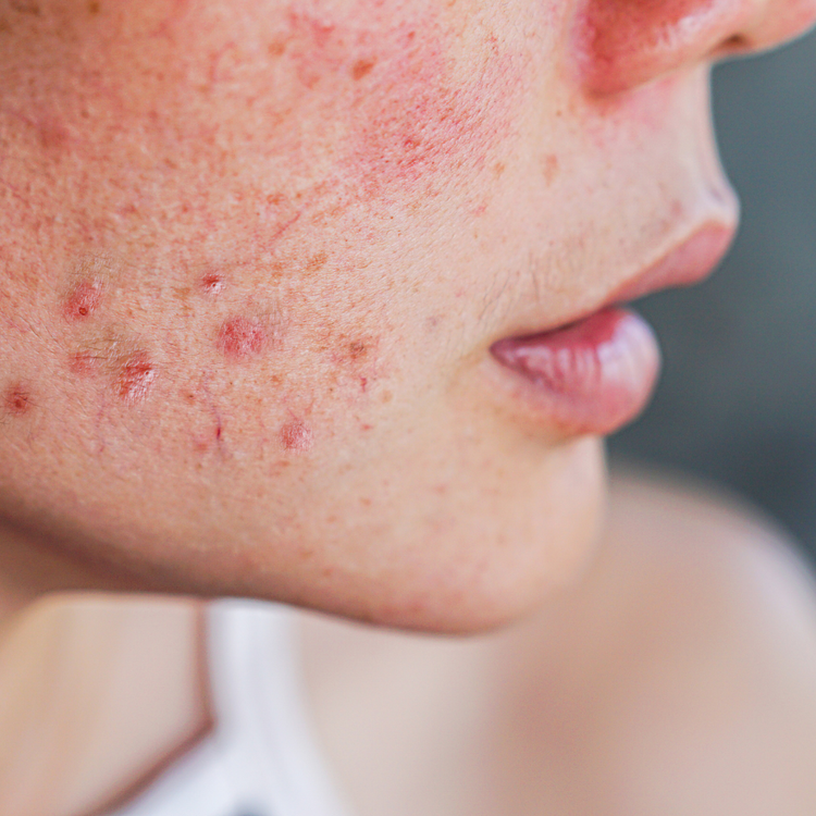 Acné et imperfections